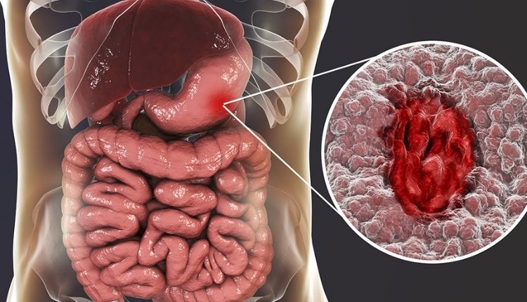 Natural Treatment of Peptic Ulcers With One Homeopathic Medicine